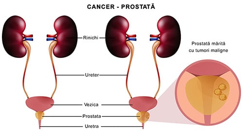 operatie cancer la prostata)